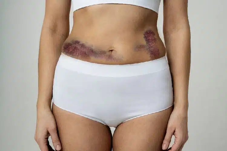 When Laser Lipo Isn’t the Right Choice: Important Health Warnings to Know